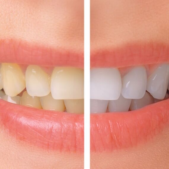 Before and after porcelain veneers transformation Scottsdale AZ