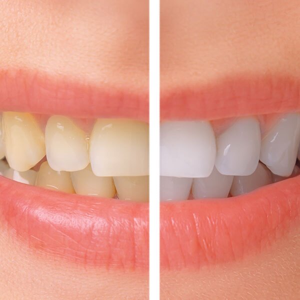 Before and after porcelain veneers transformation Scottsdale AZ