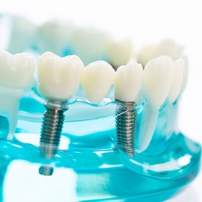 Dental implant components showing titanium post abutment and crown at S&C Dental Scottsdale