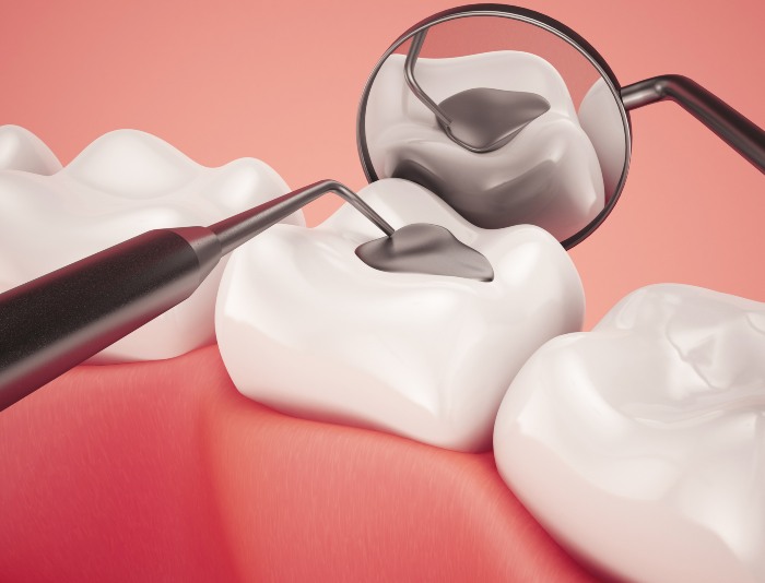 Amalgam composite Filling Checkup