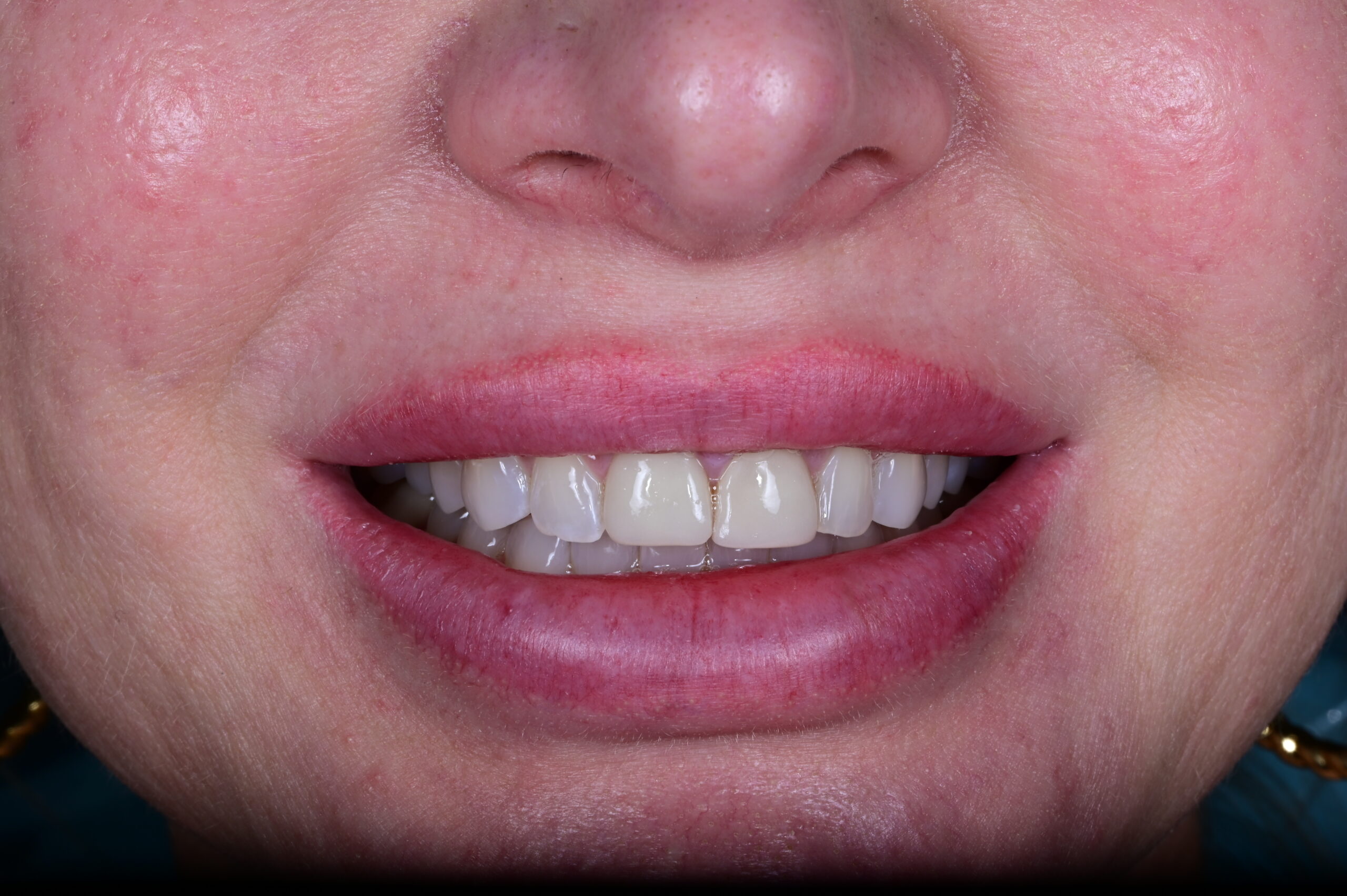 Before dental veneers discolored teeth Scottsdale patient