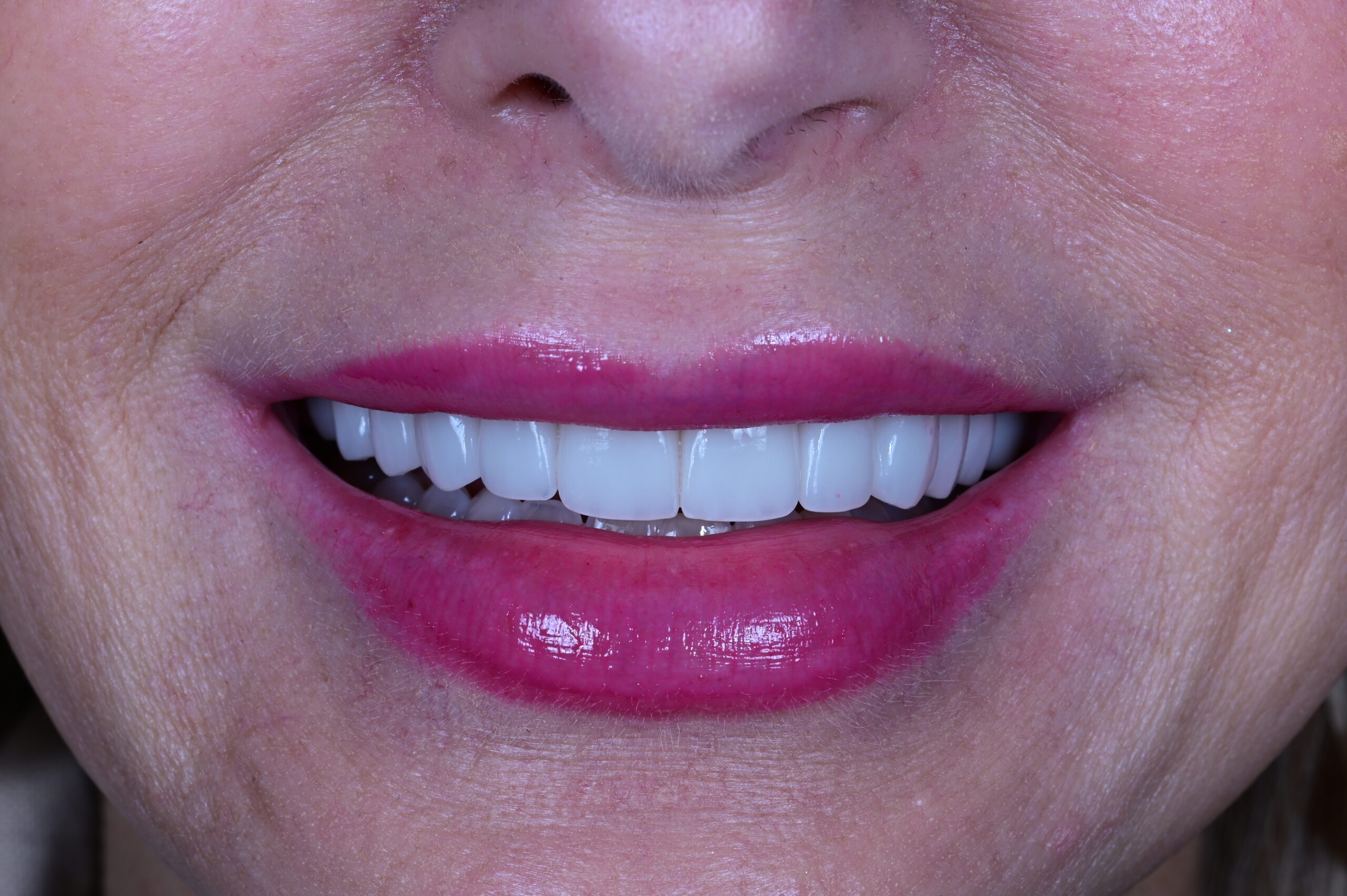 After porcelain veneers uniform bright smile S&C Dental