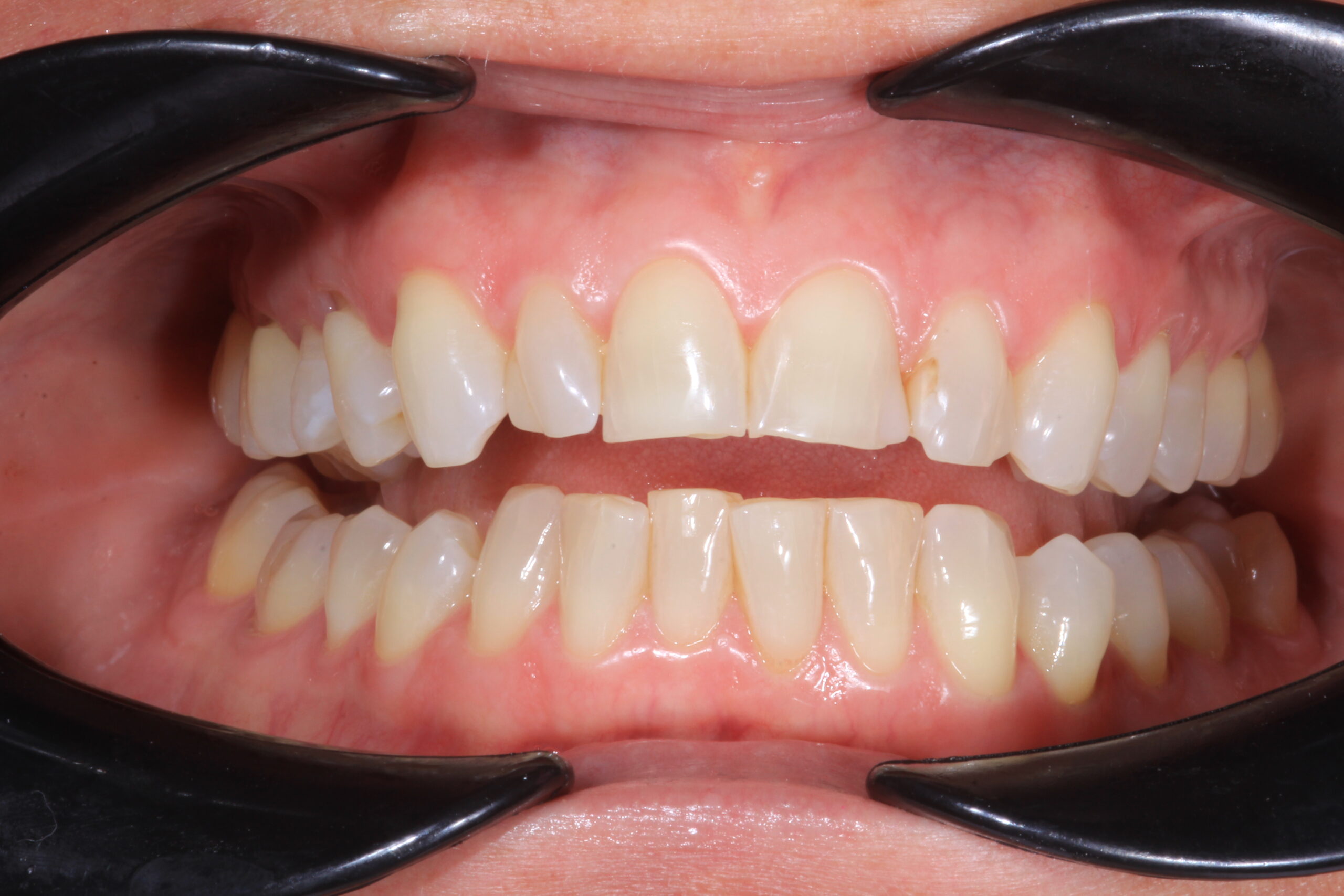 Before full arch veneers worn discolored teeth